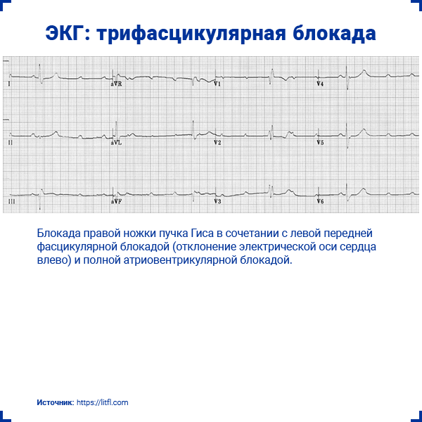 Блокада сердца лечение консультация в экспертной клинике ID-CLINIC Санкт-Петербург